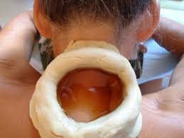Greeva Vasti traditional oil therapy applied around the neck